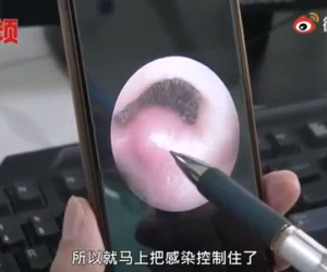 Cậu bé 8 tuổi suýt chết vì nhiễm trùng não, nguyên nhân bởi thói quen chẳng ai ngờ: Ngoáy mũi