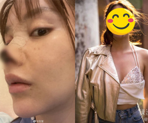 1 năm sau vụ phẫu thuật thẩm mỹ thất bại khiến mũi bị hoại tử, nhan sắc của mỹ nhân đình đám Cbiz lột xác hoàn toàn