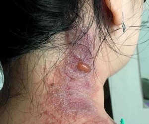 Viêm da vì kiến ba khoang, nhiều bệnh nhân gánh hậu quả mùa dịch