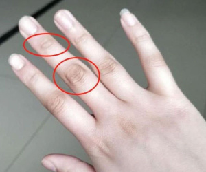 4 dấu hiệu bất thường ở ngón tay giữa cảnh báo gan đang yếu, nên đi khám ngay