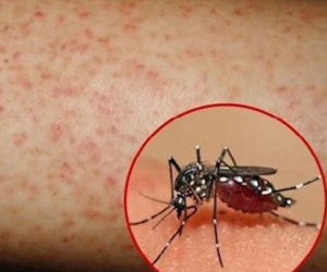 Bé gái 9 tuổi tại Hà Nội nguy kịch vì sốt xuất huyết: Bác sĩ gửi lời cảnh báo khẩn thiết tới phụ huynh
