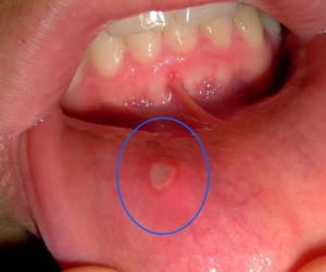 Đây là hiện tượng xuất hiện ở miệng mà 90% người mắc phải có thể là dấu hiệu cảnh báo ung thư nhưng không ai để ý