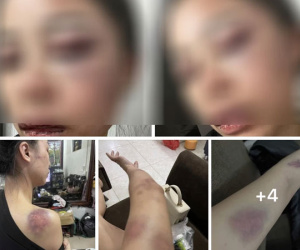 Vợ tố chồng bạo hành từ 23 giờ đêm đến 4 giờ sáng, gương mặt bị đánh tới biến dạng