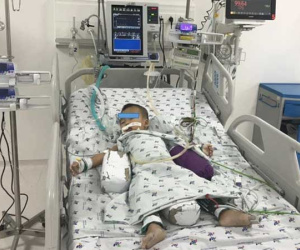 Bé trai 20 tháng tuổi nguy kịch vì mảnh xương trong nước hầm cháo đâm vào khí quản