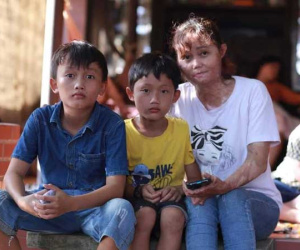 Người phụ nữ bị chồng thiêu sống bỏng đến 92%: 'Khi các con đã đi ngủ, tôi khóc ướt gối'