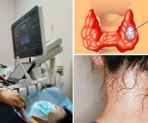 Cô gái trẻ 25 tuổi bị bệnh tuyến giáp giai đoạn cuối, bác sĩ nói: Cẩn thận với một kiểu đổ mồ hôi