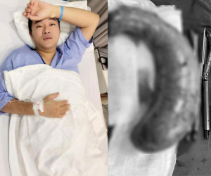 Ca sĩ Minh Quân gây choáng khi đăng ảnh dạ dày của mình bị cắt đến 80%, tiết lộ đã sút 10kg sau cuộc đại phẫu