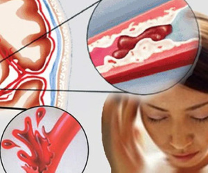 12 tuổi đã bị tai biến mạch máu não, BS cảnh báo 6 việc người trẻ hay làm khiến bệnh tật đến nhanh
