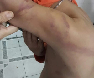 Cha đánh con lớp 1 thâm tím người vì học không tiến bộ