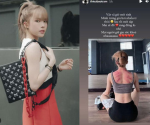 Thiều Bảo Trâm lên tiếng trấn an mọi người sau khi cơ thể lộ nhiều vết đỏ bầm nhưng lại bị anti-fan mắng mỏ nặng lời