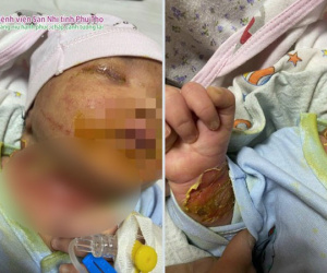 Bé gái sơ sinh lở loét toàn thân, nghi nhiễm trùng máu do mẹ sợ Covid-19, tự đắp thuốc điều trị cho con