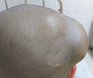 Bé 12 tuổi thường xuyên đau đầu, thời gian ngắn sau u não 'đội lên' to bằng quả trứng