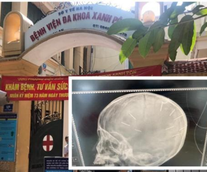 Vụ bé gái bị ghim 9 chiếc đinh trong đầu: Cục Trẻ em hé lộ nội dung cuộc điện thoại cầu cứu