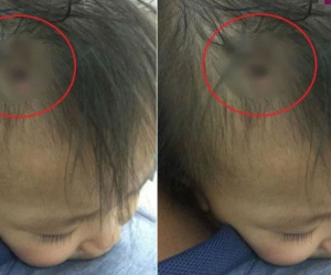 Sự thật về bức ảnh bé gái 3 tuổi bị bạo hành với chiếc đinh lớn cắm thẳng vào đầu khiến MXH xôn xao