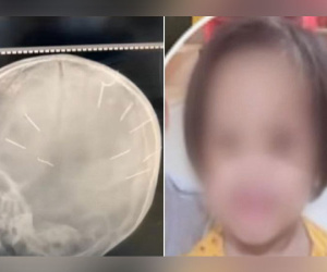 Những tình tiết mới vụ bé gái bị 9 chiếc đinh găm vào đầu