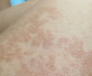 Cô gái 27 tuổi ở TP.HCM khổ sở vì da loang lổ sau khi khỏi Covid-19