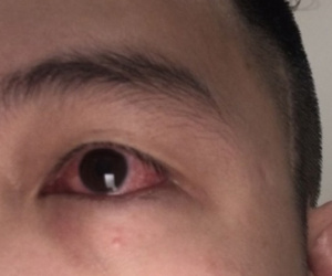 F0 bị đỏ mắt, bác sĩ cảnh báo 'triệu chứng không thể chủ quan'