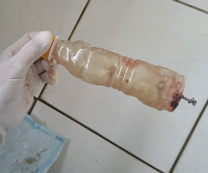 Mắc kẹt dị vật khủng trong hậu môn, thầy phán 'bị yểm bùa trong bụng'