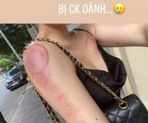 Vân Navy bị chồng đánh, thương tích đầy mình?