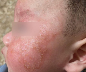 Kiêng tắm 6 ngày khi mắc Covid-19, da trẻ đóng vảy, đỏ lừ