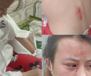 Nữ sinh lớp 10 bị hàng xóm hành hung đến ‘chấn động não’