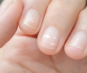 Dấu hiệu nhỏ trên móng tay cảnh báo nhiều nguy cơ tiềm ẩn