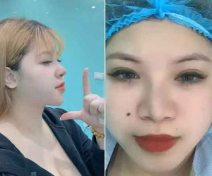 Hết hút 6 lít mỡ, 'hot girl ngực khủng' lại dao kéo mặt tiền