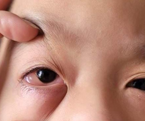 Trẻ sưng đỏ mắt, than đau đầu có thực sự do hậu Covid-19?