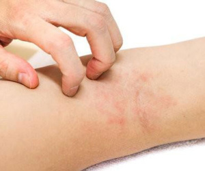 Ngứa da điên cuồng, có thể bạn đã mắc phải một trong các 'trọng bệnh' sau