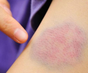 Đột nhiên xuất hiện vết bầm tím trên da coi chừng mắc 5 bệnh nguy hiểm: Chuyên gia cảnh báo dấu hiệu cần đi khám sớm