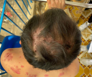 Nam thanh niên mắc phải căn bệnh cực hiếm, cả thế giới chỉ có 95 người
