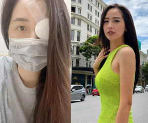 Mai Phương Thúy xuất hiện bơ phờ, mắt băng bó kín mít
