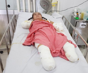 Người phụ nữ mất cả tứ chi vì điện giật khi dùng cây sắt hái xoài cho con