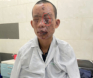 Cháy sém toàn thân, mất thị lực do dùng điện thoại khi đang sạc
