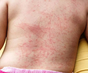 Sốt xuất huyết gần vào mùa: Triệu chứng, nguyên nhân và cách phòng tránh