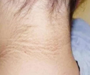 Ung thư trong cơ thể, tiên tri cổ? Xin nhắc lại: Có 3 dấu hiệu bất thường ở cổ, có thể là ung thư đang đến gần