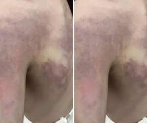 Học sinh lớp 3 nghi bị cô giáo dùng thước đánh tím người vì... không làm được bài