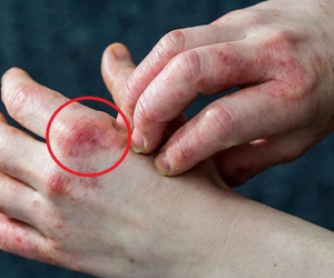 8 dấu hiệu cảnh báo đường huyết tăng vọt và cách xử lý
