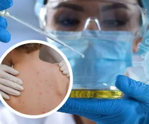 120 ca mắc, nghi mắc đậu mùa khỉ trên thế giới, Việt Nam giám sát chặt chẽ