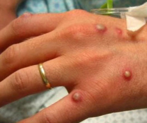 Bệnh đậu mùa khỉ bùng phát: Triệu chứng, cách phòng ngừa và điều trị