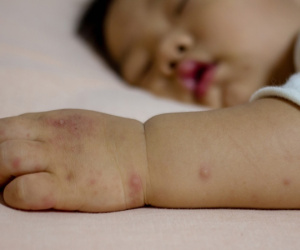 Chăm sóc trẻ bị tay chân miệng tại nhà: Cha mẹ cần lưu ý gì nếu không muốn con phải nhập viện, thở máy?