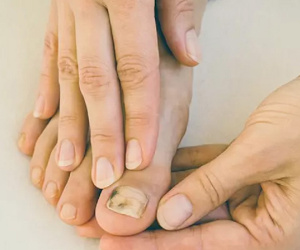 Phát hiện mắc ung thư nhờ điểm lạ ở ngón chân: Dấu hiệu bất thường ở móng cảnh báo bệnh, ai cũng nên cảnh giác