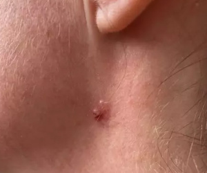 Cô gái phát hiện bị ung thư khi nốt ruồi đổi màu sau một đêm