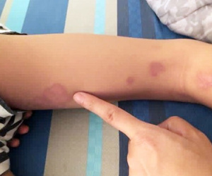 Phát hiện 1 bệnh nhi mắc bệnh 'vi khuẩn ăn thịt người'
