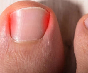 Chàng trai 18 tuổi tử vong vì móng chân mọc ngược: Từng khám 4 lần nhưng BS không phát hiện ra bệnh