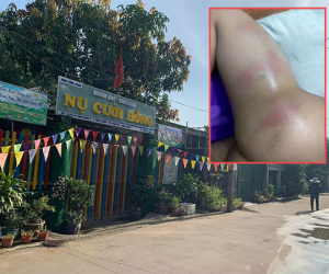 Bé gái 4 tuổi bị cô giáo đánh tím người vì đi vệ sinh ra quần