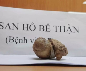 Thói quen thường gặp khiến thận mất hoàn toàn chức năng