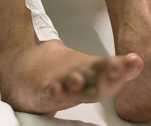 Chân đau như chuột rút rồi đen xì ngón chân, tới bệnh viện phải cắt bỏ