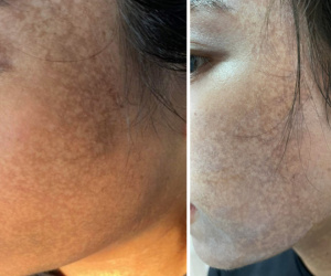 Mặt cô gái trẻ 'cháy đen' sau khi chi 70 triệu đồng để lăn kim, lột da trị nám tại spa