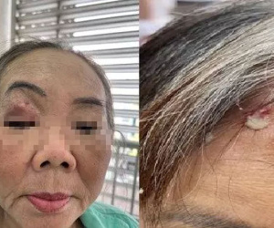 Nguyên nhân nào khiến hàng loạt người bệnh hoại tử xương hàm, xương sọ?